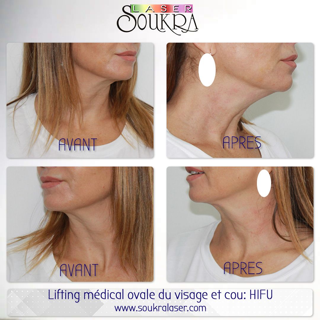 Lifting médical ovale du visage et cou