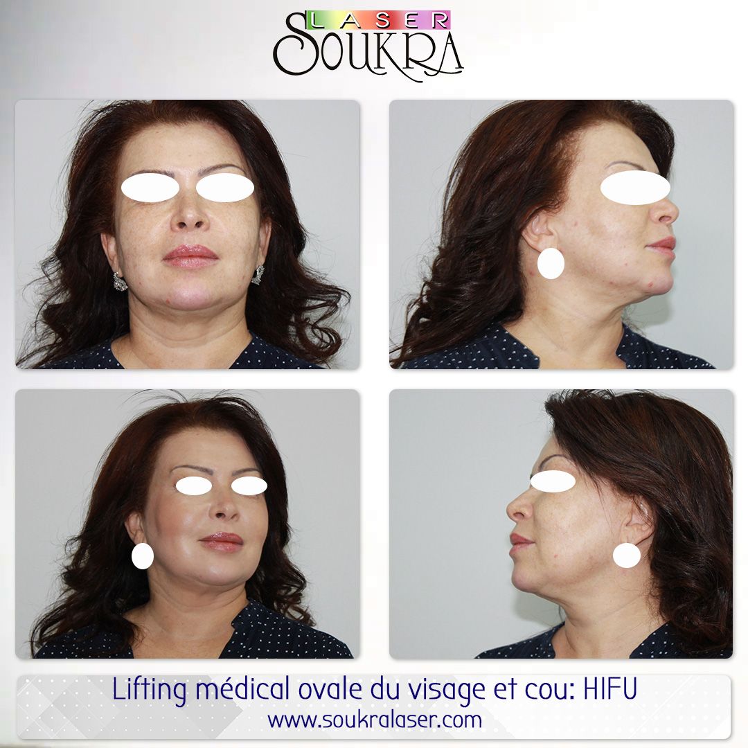 Lifting médical ovale du visage et cou