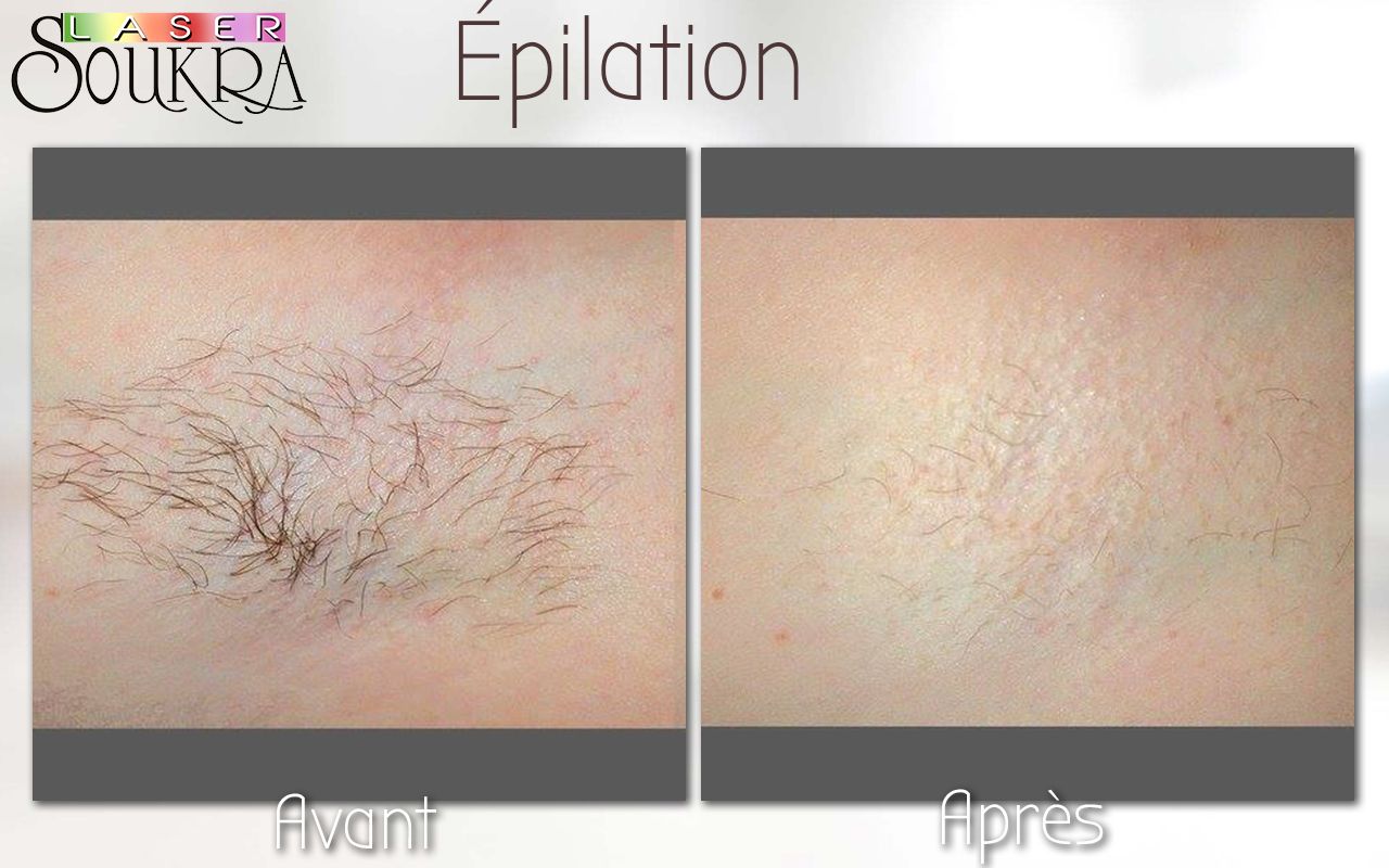 Epilation Laser