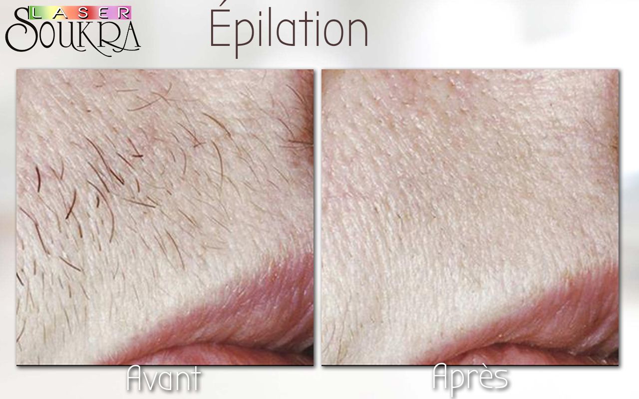 Epilation Laser