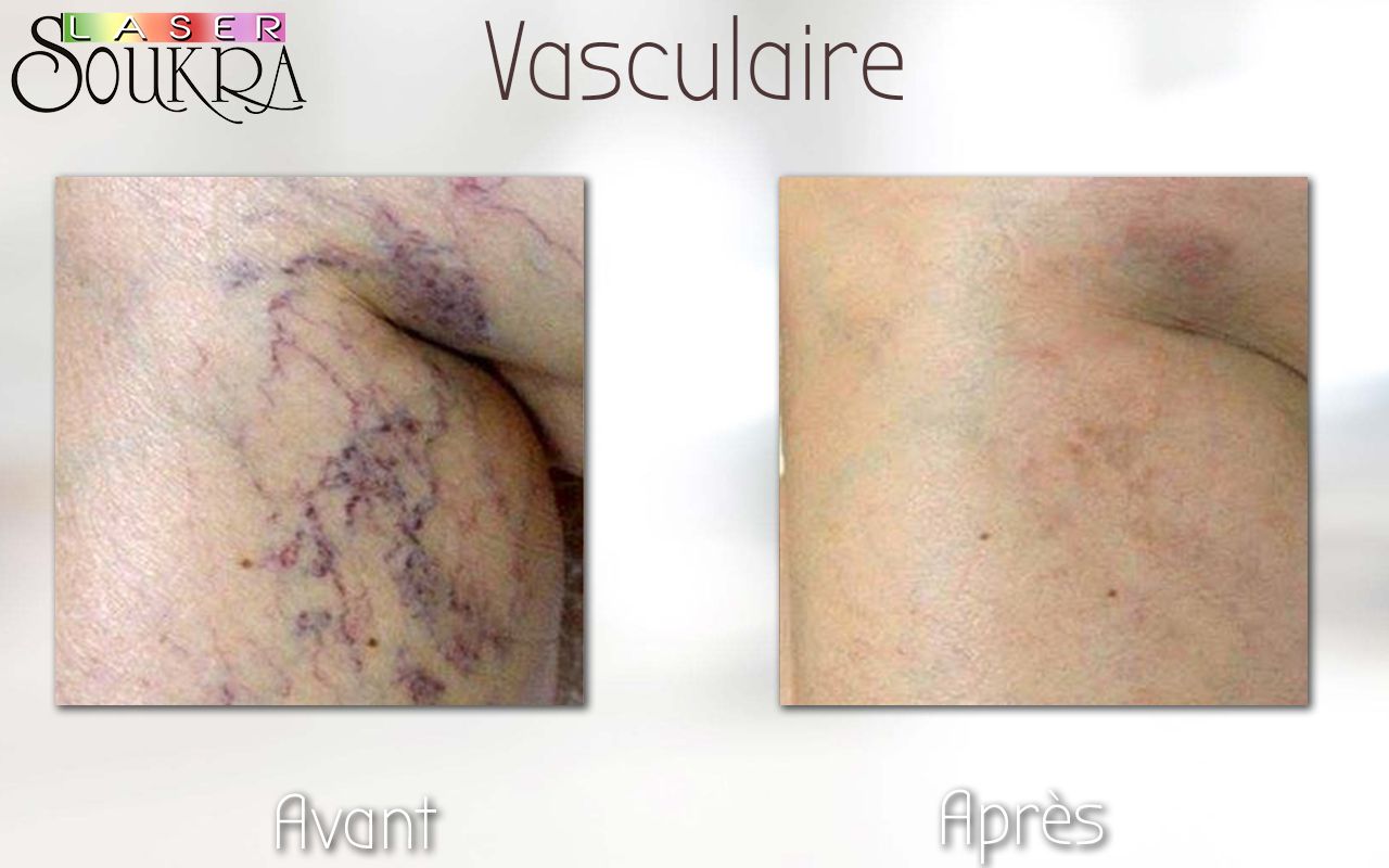 Lésions vasculaires