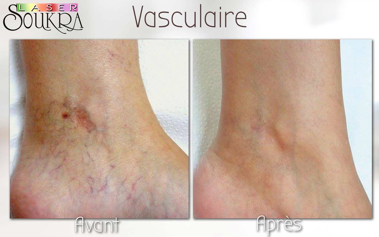 Lésions vasculaires