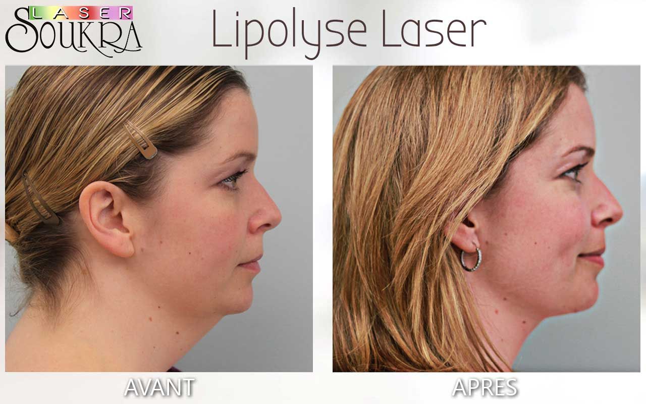 Lipolyse du double menton
