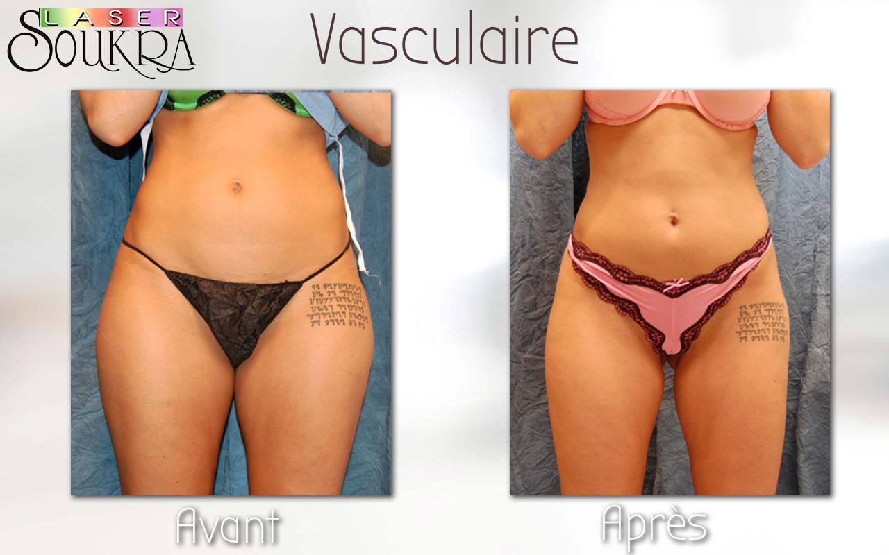 Lipolyse du ventre et de l'intérieur des cuisses