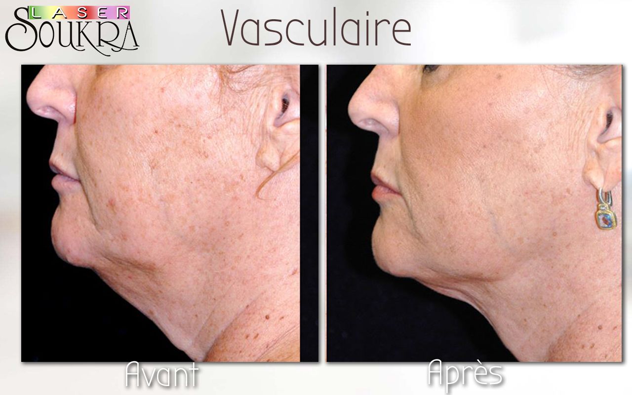 Lipolyse du double menton