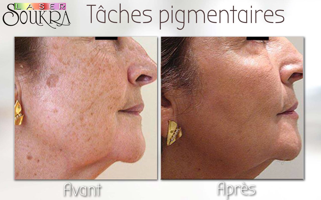 Lésions pigmentaires