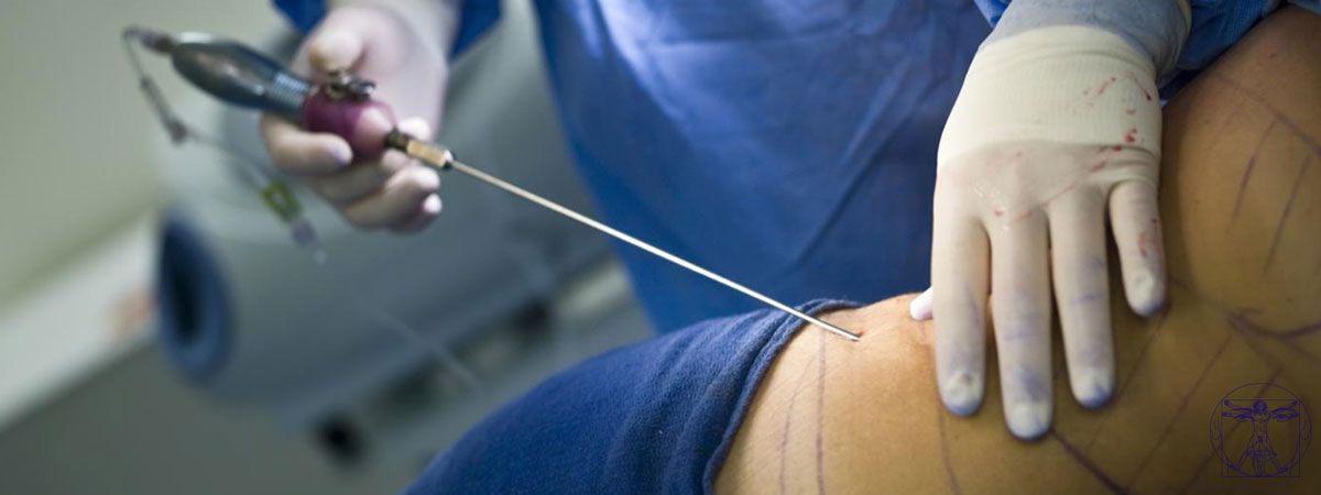 Lipolyse laser
