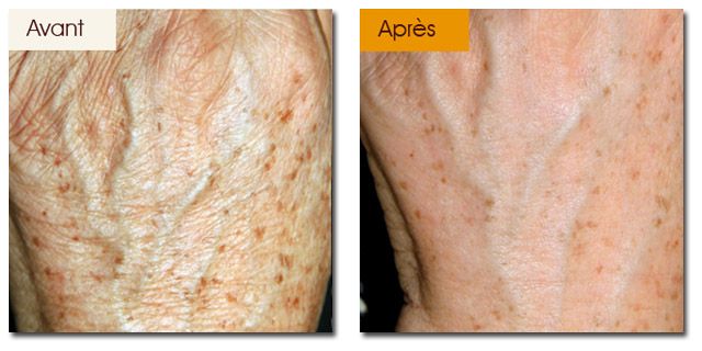 Lésions pigmentaires