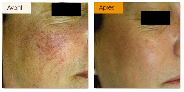 Lésions vasculaires