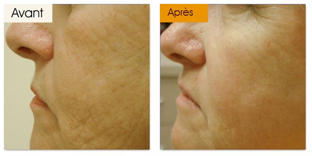 Photo Rajeunissement